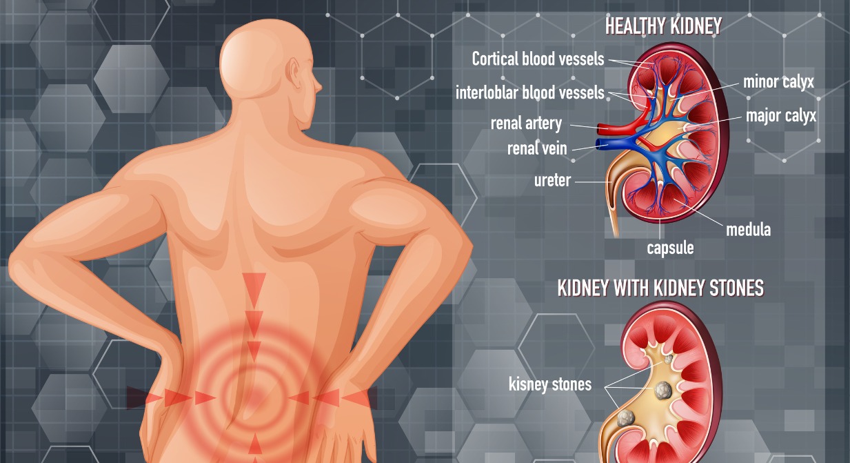 homeopathic remedy for kidney stones